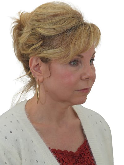 Facelift/Neck Lift Before & After Gallery - Patient 155008578 - Image 1
