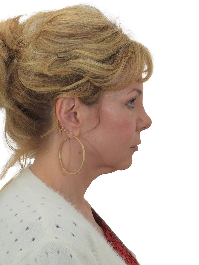 Facelift/Neck Lift Before & After Gallery - Patient 155008578 - Image 3