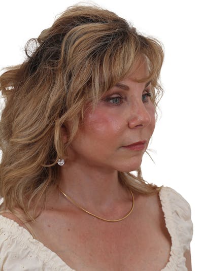 Facelift/Neck Lift Before & After Gallery - Patient 155008578 - Image 2