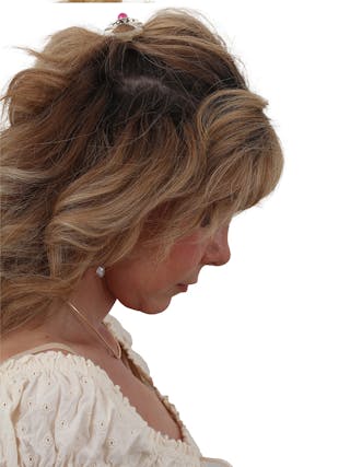 Blepharoplasty Before & After Gallery - Patient 155008907 - Image 6