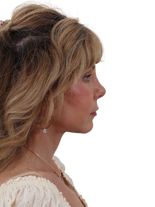 Blepharoplasty Before & After Gallery - Patient 155008907 - Image 2