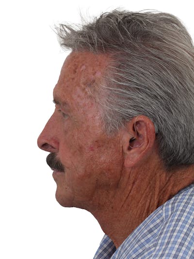 Facelift/Neck Lift Before & After Gallery - Patient 155008577 - Image 2