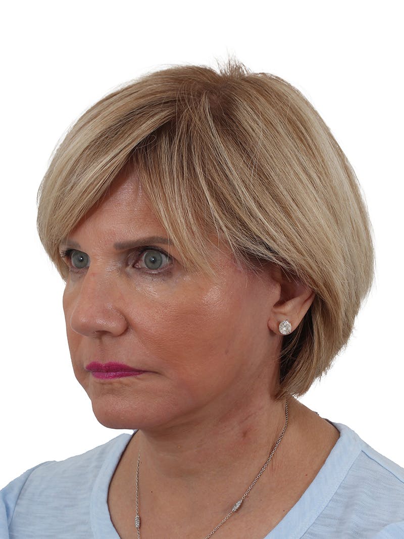 Facelift/Neck Lift Before & After Gallery - Patient 155008582 - Image 2