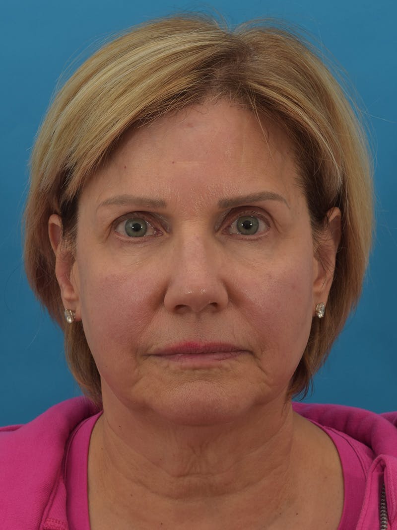 Facelift/Neck Lift Before & After Gallery - Patient 155008582 - Image 5