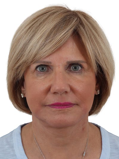 Facelift/Neck Lift Before & After Gallery - Patient 155008582 - Image 2