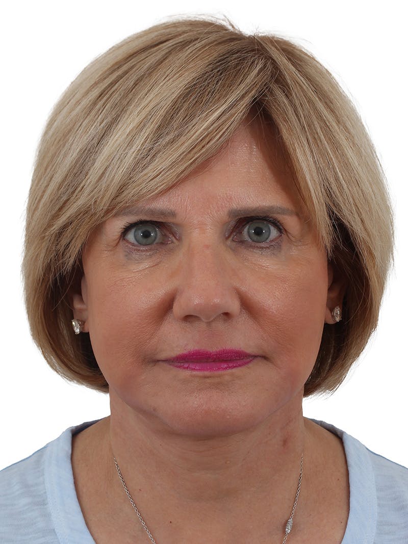 Facelift/Neck Lift Before & After Gallery - Patient 155008582 - Image 2