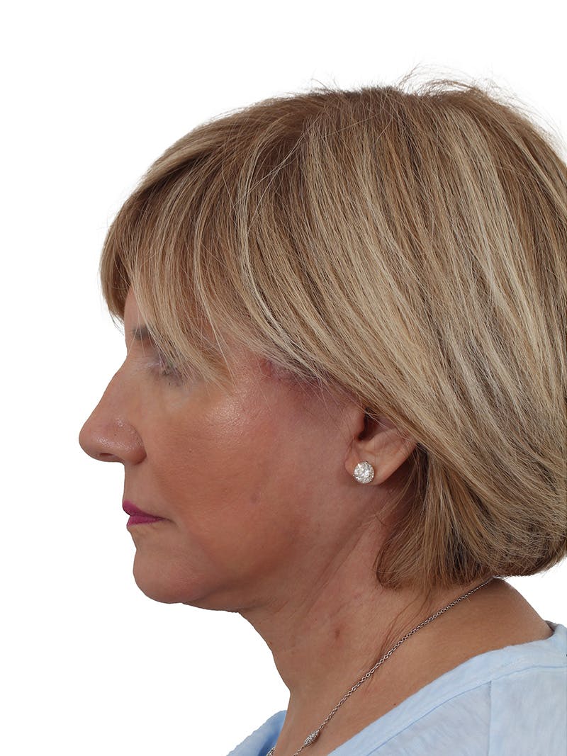 Facelift/Neck Lift Before & After Gallery - Patient 155008582 - Image 12