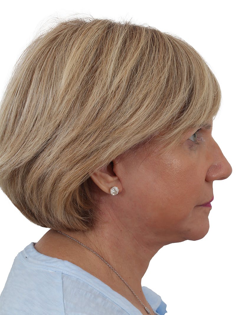 Facelift/Neck Lift Before & After Gallery - Patient 155008582 - Image 8