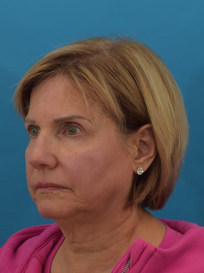Facelift/Neck Lift Before & After Gallery - Patient 155008582 - Image 1