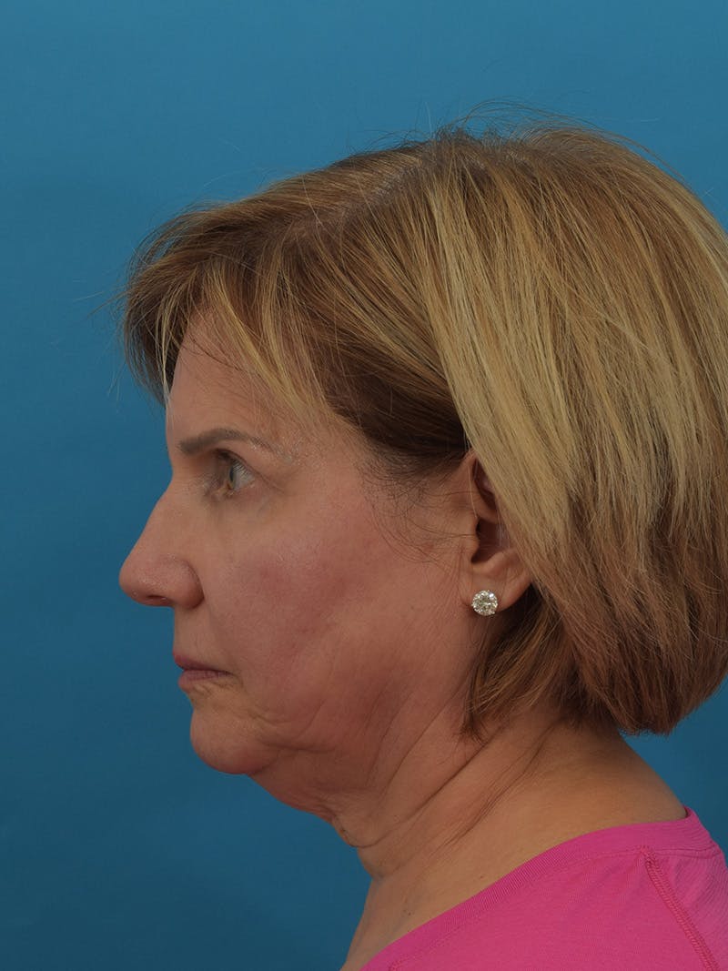 Facelift/Neck Lift Before & After Gallery - Patient 155008582 - Image 13