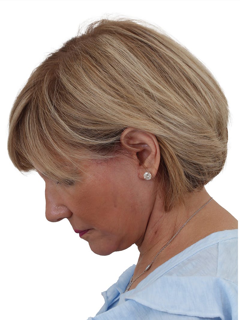 Facelift/Neck Lift Before & After Gallery - Patient 155008582 - Image 12
