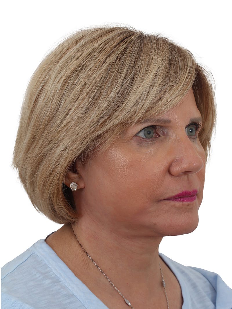 Facelift/Neck Lift Before & After Gallery - Patient 155008582 - Image 4