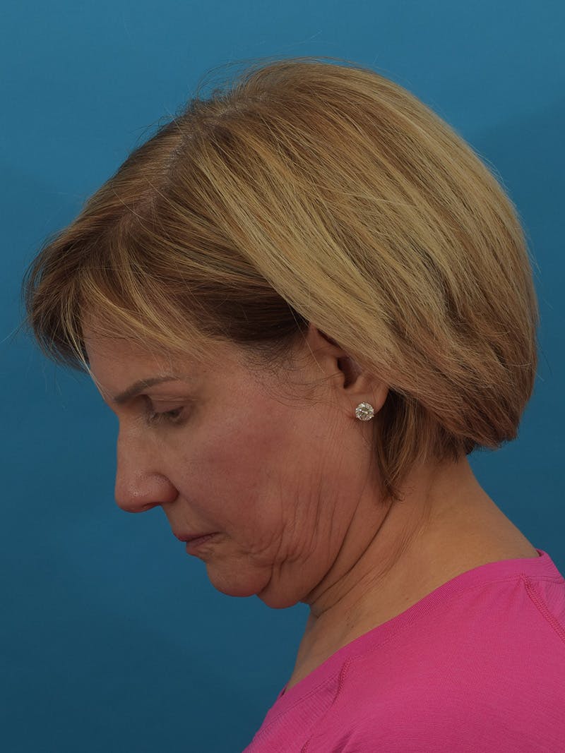 Facelift/Neck Lift Before & After Gallery - Patient 155008582 - Image 9