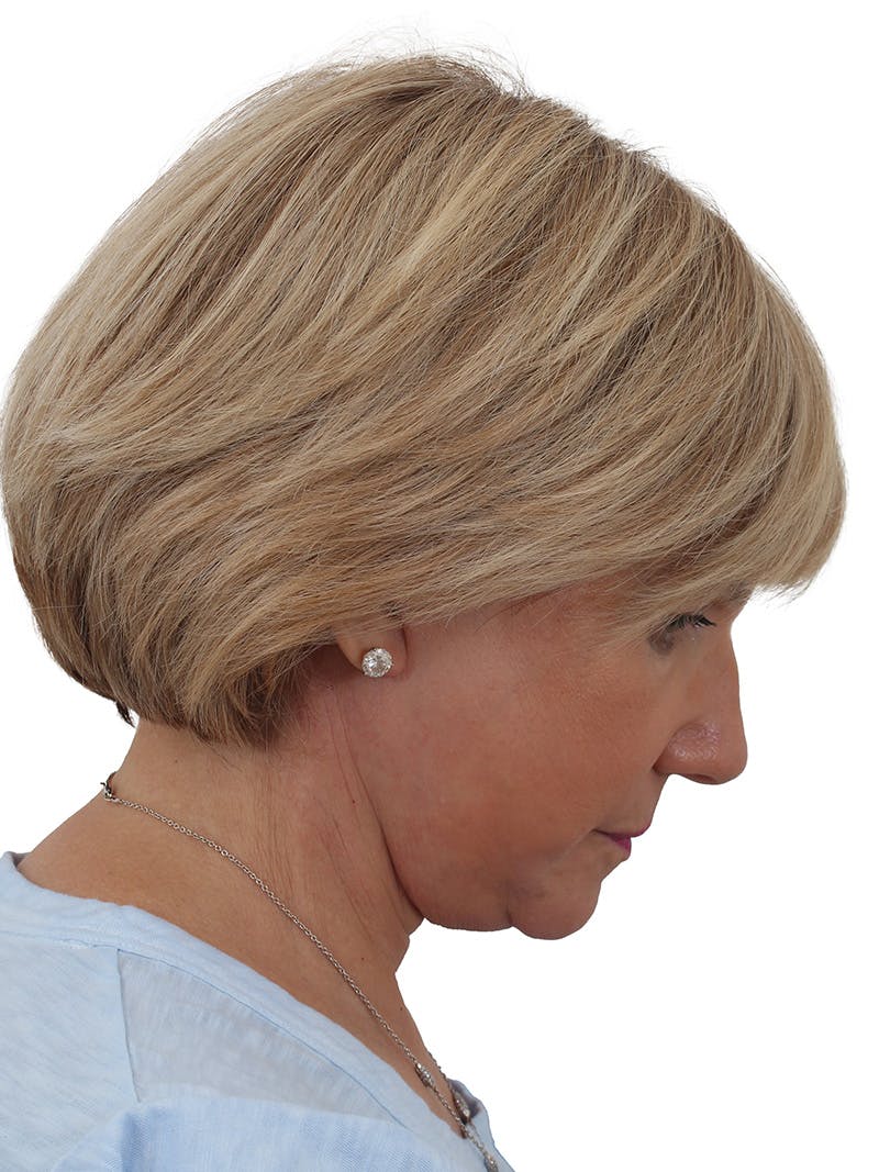 Facelift/Neck Lift Before & After Gallery - Patient 155008582 - Image 10