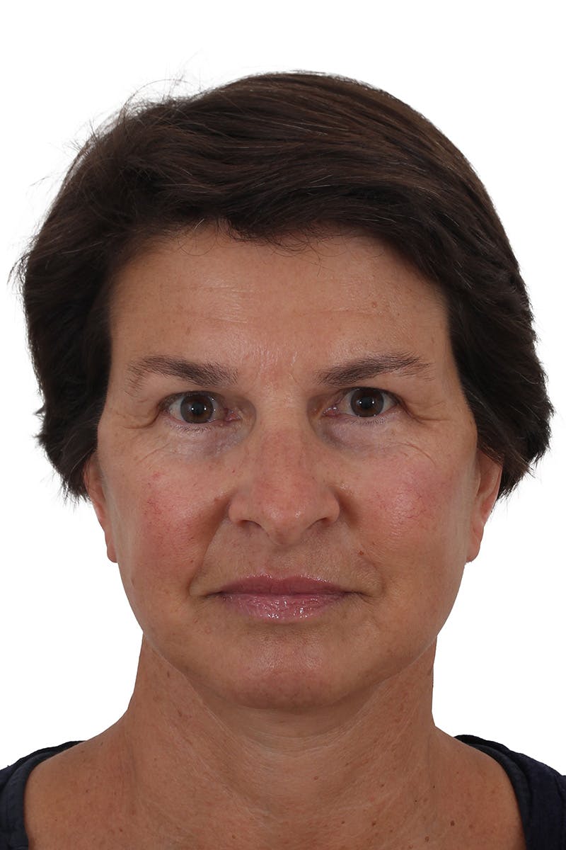 Facelift/Neck Lift Before & After Gallery - Patient 148022915 - Image 4