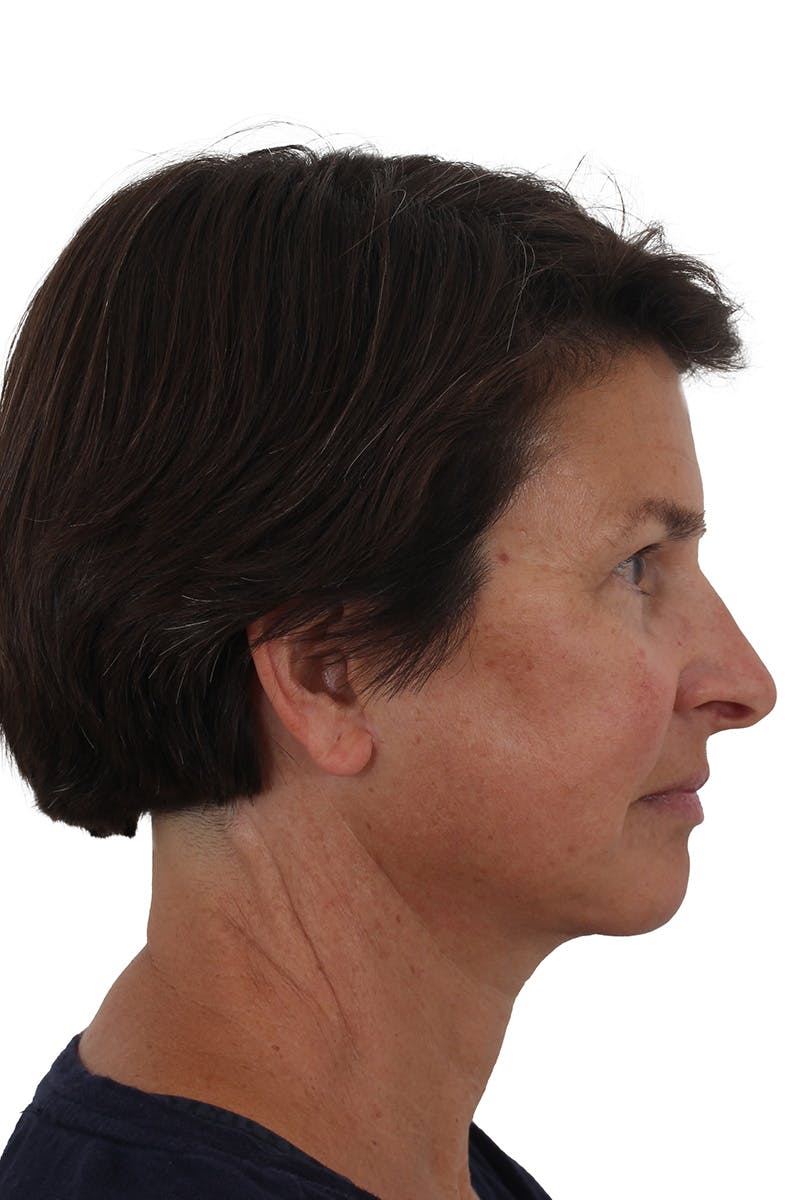 Facelift/Neck Lift Before & After Gallery - Patient 148022915 - Image 6