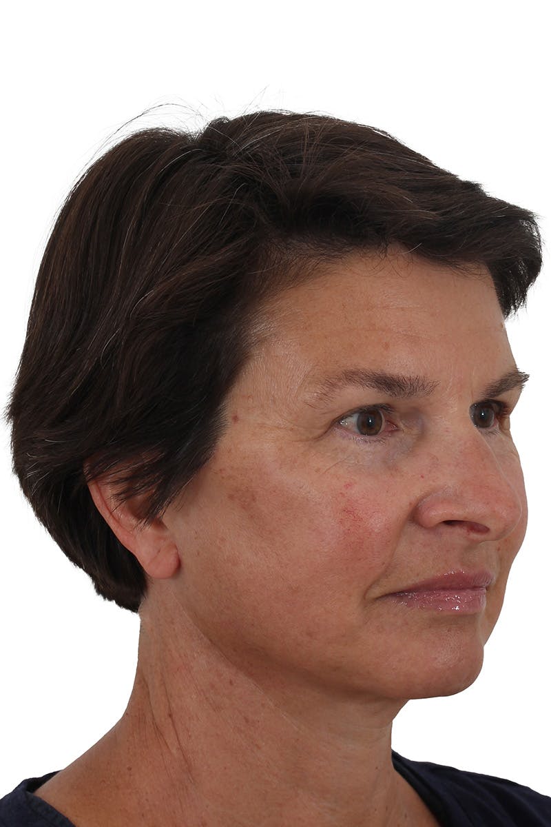 Facelift/Neck Lift Before & After Gallery - Patient 148022915 - Image 4