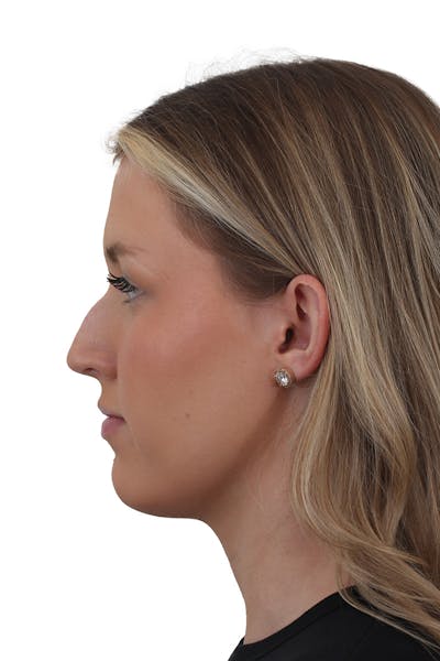 Filler - Liquid Rhinoplasty Before & After Gallery - Patient 155008916 - Image 1