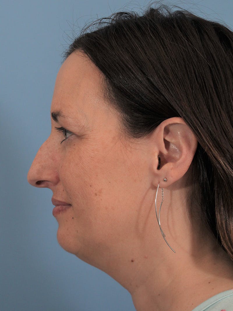 Rhinoplasty Before & After Gallery - Patient 165420035 - Image 1