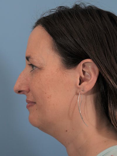 Rhinoplasty Before & After Gallery - Patient 165420035 - Image 1