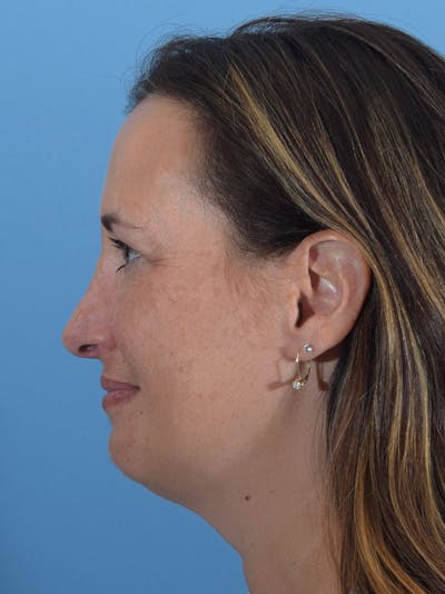 Rhinoplasty Before & After Gallery - Patient 165420035 - Image 2