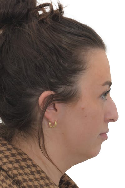Chin Augmentation Before & After Gallery - Patient 149296853 - Image 1