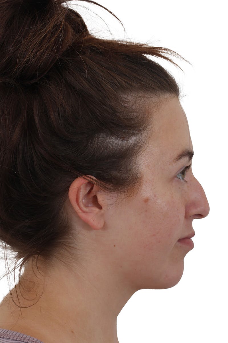 Chin Augmentation Before & After Gallery - Patient 149296853 - Image 2