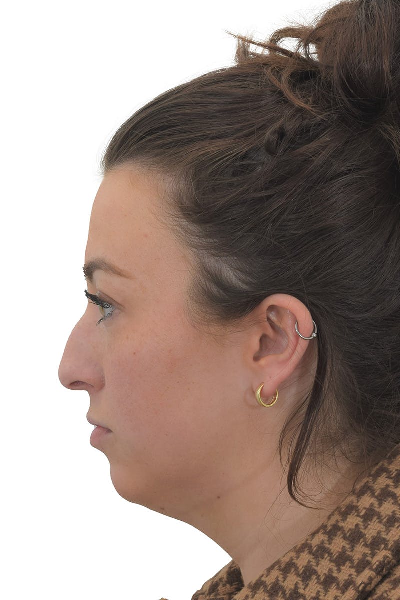 Chin Augmentation Before & After Gallery - Patient 149296853 - Image 3
