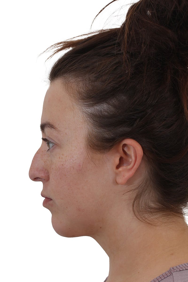 Chin Augmentation Before & After Gallery - Patient 149296853 - Image 4