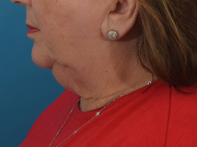Facelift/Neck Lift Before & After Gallery - Patient 174592028 - Image 1