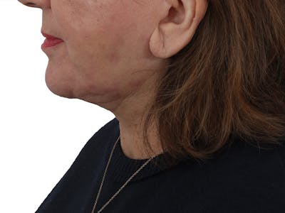 Facelift/Neck Lift Before & After Gallery - Patient 174592028 - Image 2