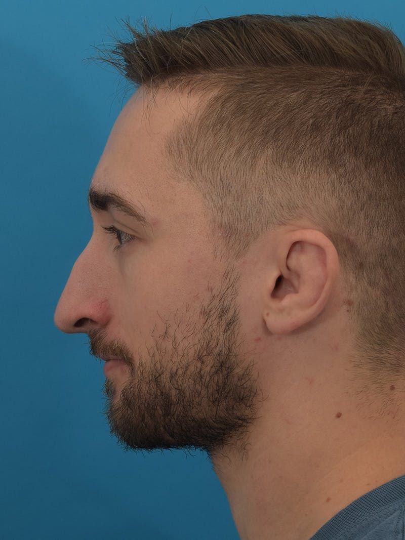 Rhinoplasty Before & After Gallery - Patient 174592688 - Image 1