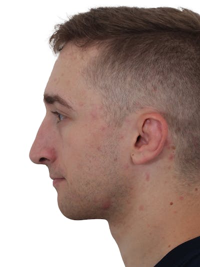 Rhinoplasty Before & After Gallery - Patient 174592688 - Image 2