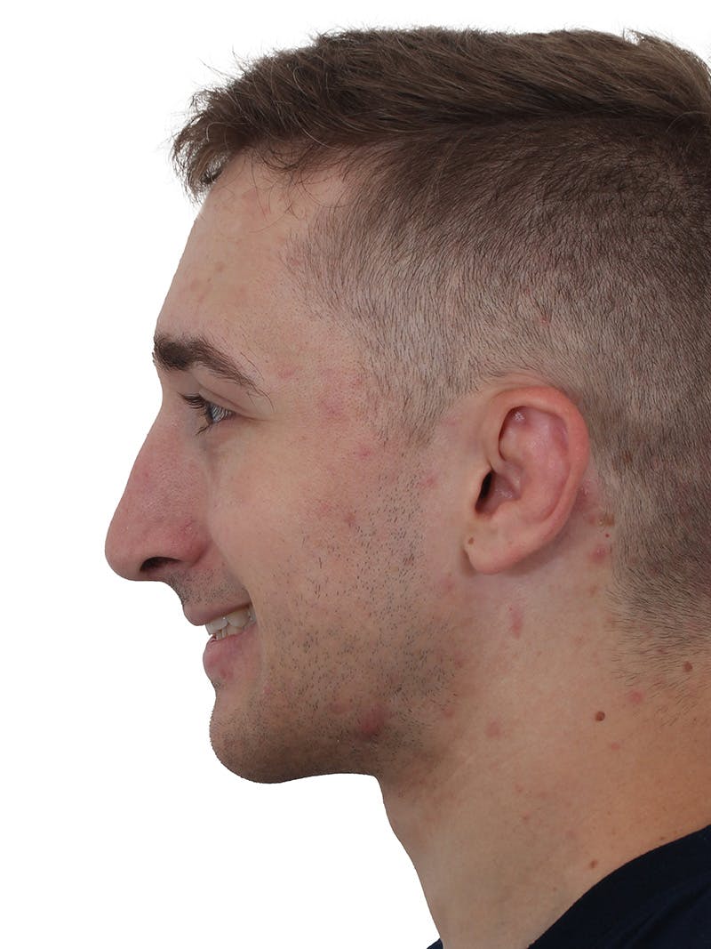 Rhinoplasty Before & After Gallery - Patient 174592688 - Image 4