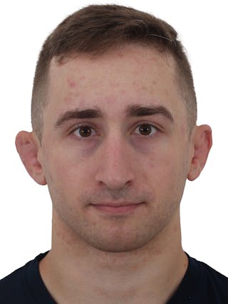 Rhinoplasty Before & After Gallery - Patient 174592688 - Image 8