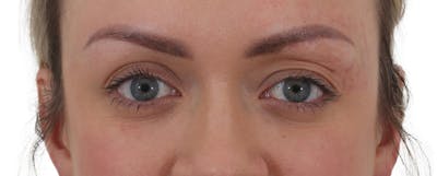 Blepharoplasty Before & After Gallery - Patient 174592690 - Image 1