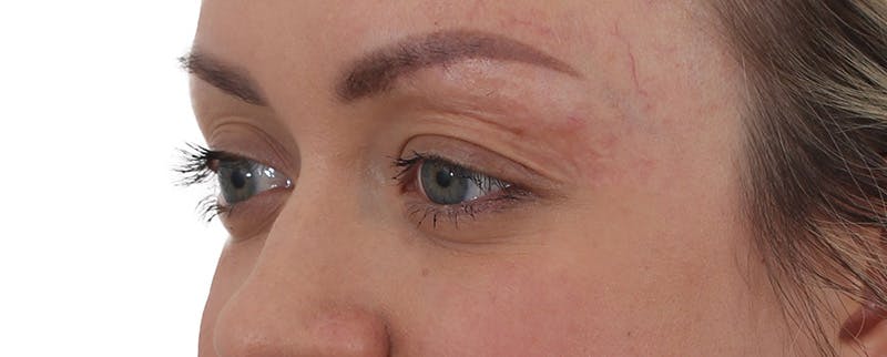 Blepharoplasty Before & After Gallery - Patient 174592690 - Image 3