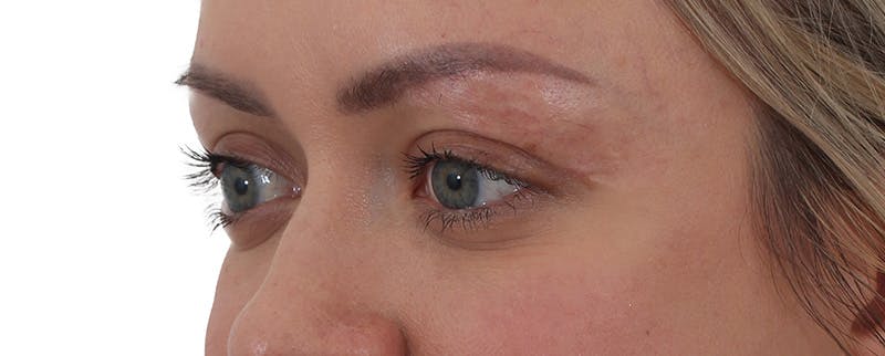 Blepharoplasty Before & After Gallery - Patient 174592690 - Image 4