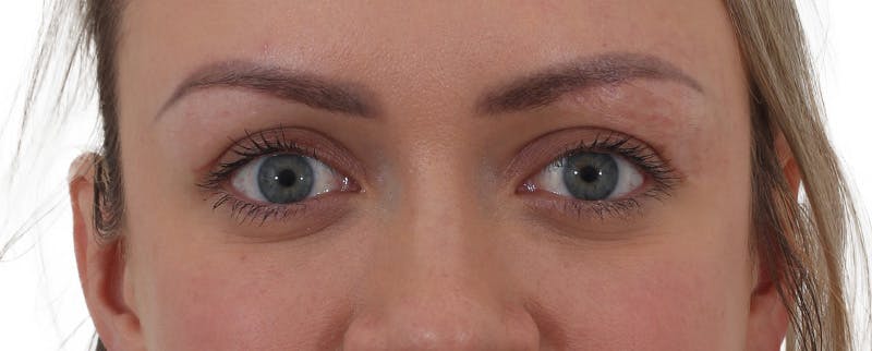 Blepharoplasty Before & After Gallery - Patient 174592690 - Image 2