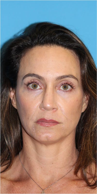 Blepharoplasty Before & After Gallery - Patient 123718801 - Image 1