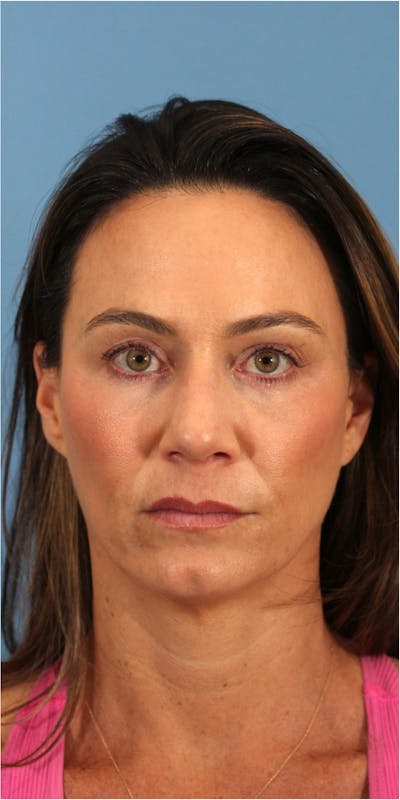 Blepharoplasty Before & After Gallery - Patient 123718801 - Image 2