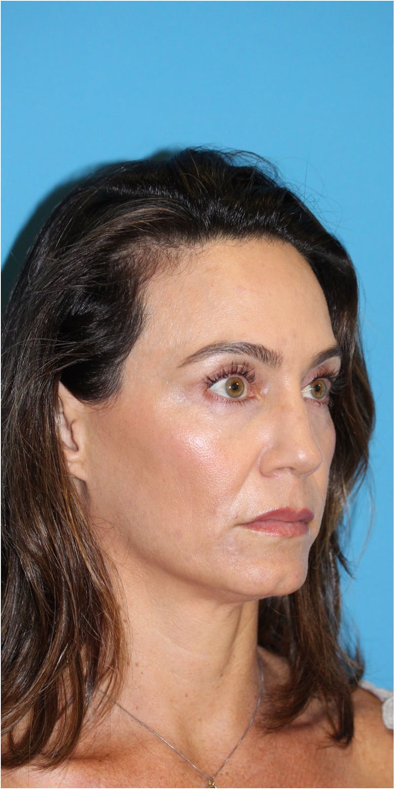 Blepharoplasty Before & After Gallery - Patient 123718801 - Image 3