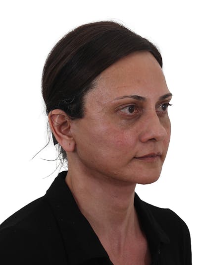 Facelift/Neck Lift Before & After Gallery - Patient 184655468 - Image 2