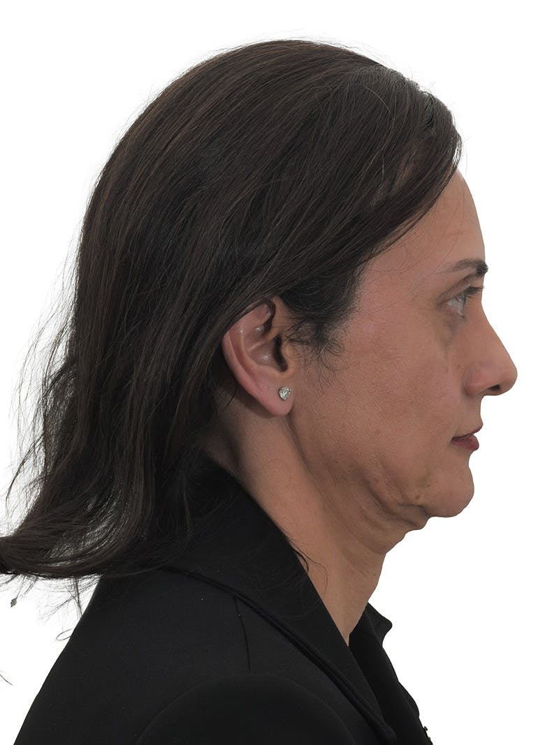 Facelift/Neck Lift Before & After Gallery - Patient 184655468 - Image 5