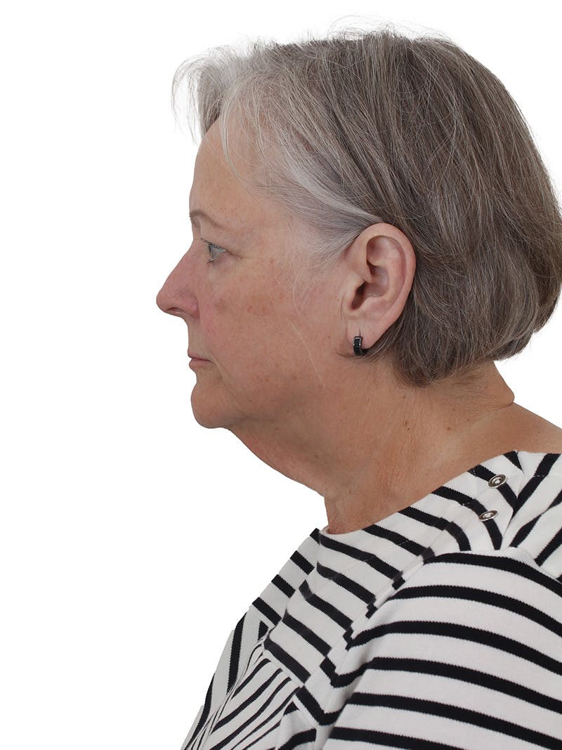 Facelift/Neck Lift Before & After Gallery - Patient 190150076 - Image 1