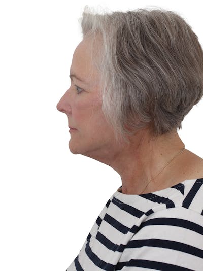 Facelift/Neck Lift Before & After Gallery - Patient 190150076 - Image 2