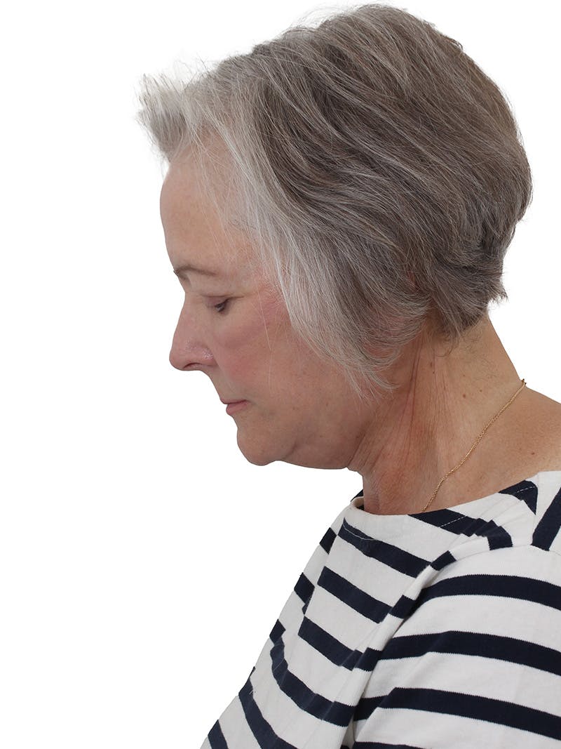 Facelift/Neck Lift Before & After Gallery - Patient 190150076 - Image 4