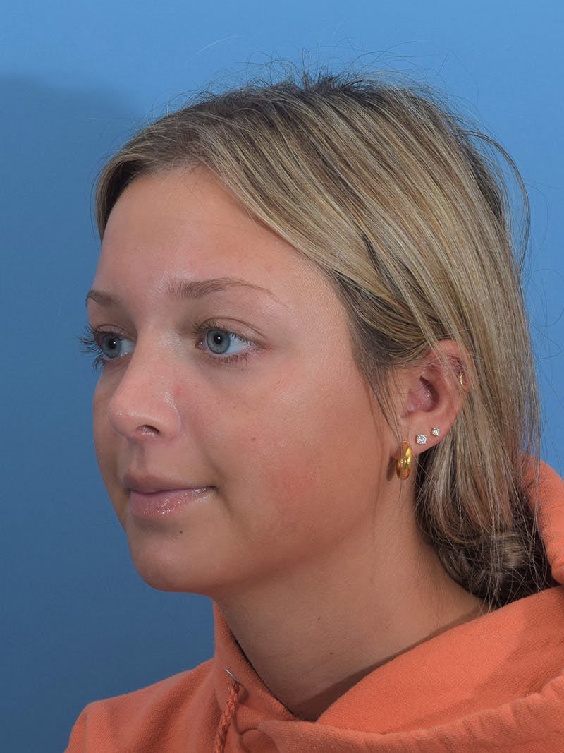 Rhinoplasty Before & After Gallery - Patient 404843 - Image 4