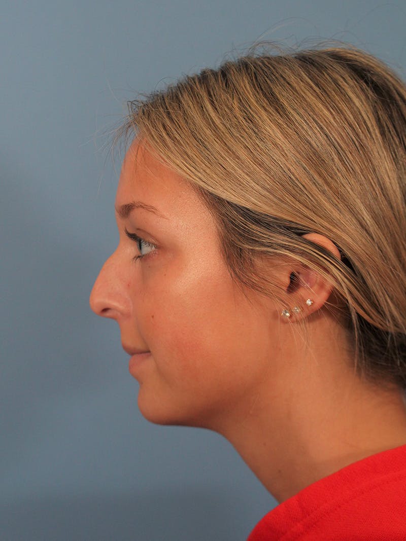 Rhinoplasty Before & After Gallery - Patient 404843 - Image 1