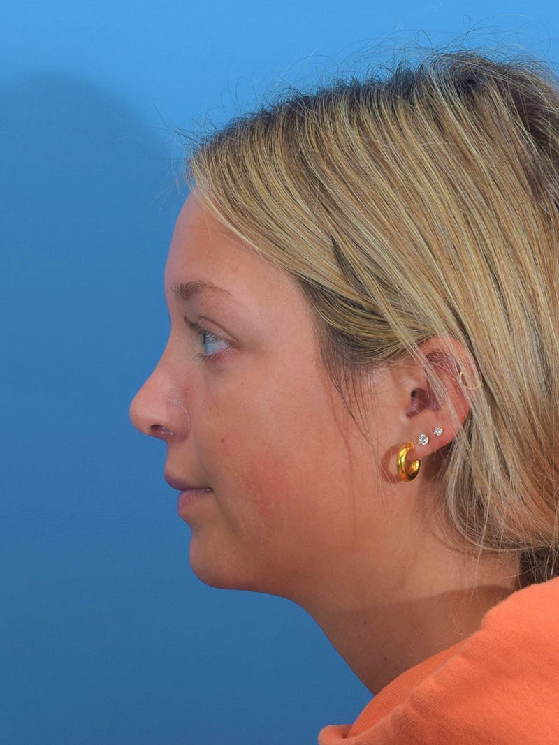 Rhinoplasty Before & After Gallery - Patient 404843 - Image 2